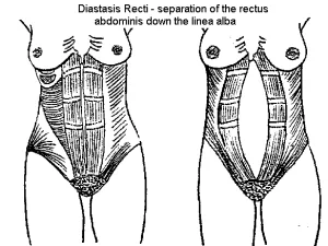 Diastasis 2